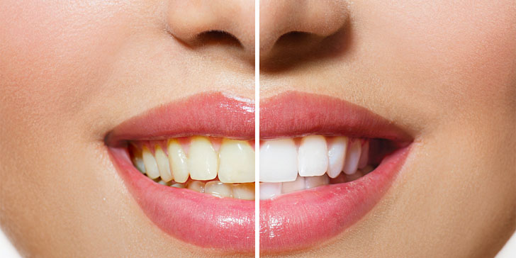 4 Ways To Naturally Whiten Your Teeth At Home