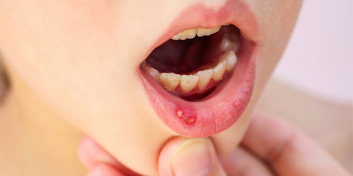 12 Amazing Home Remedies To Get Rid Of Canker Sores